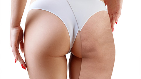 Intralipoterapia