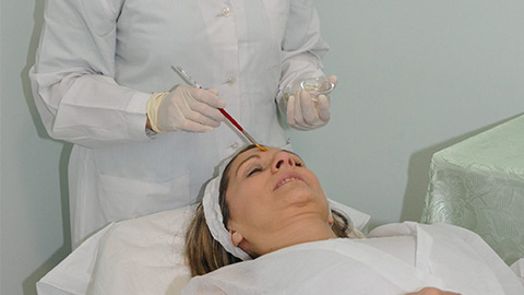 Peeling chimico